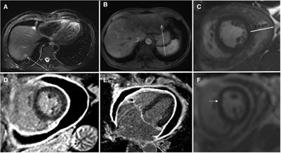 Case report: Acute pericarditis following hepatic microwave ablation for liver metastasis